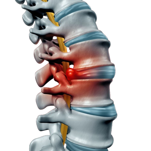 Cervical and Lumbar Disc Treatment illustration